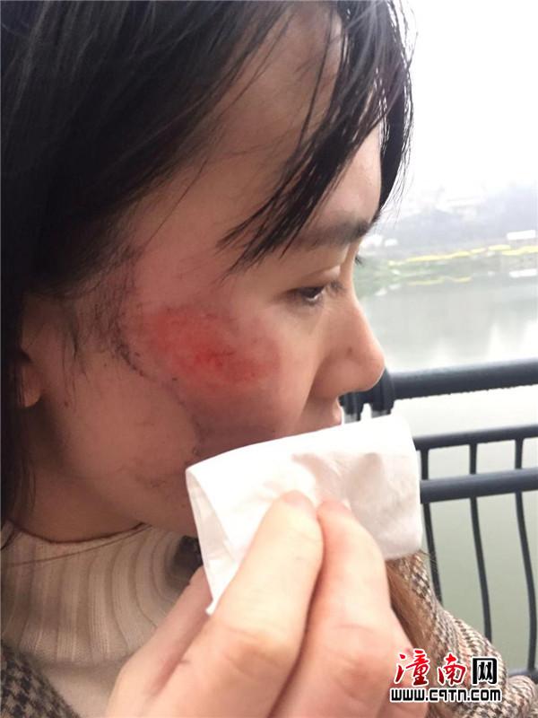 受伤女孩脸上伤疤